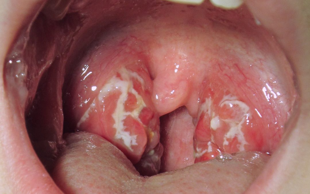 Dr. Naval Parikh: Sore Throat Signs, Causes and Treatment