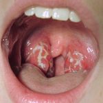 Sore Throat Signs, Causes and Treatment