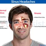 Headaches Causes, Symptoms & Treatment