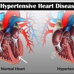 Hypertension Symptoms, Causes & Treatments