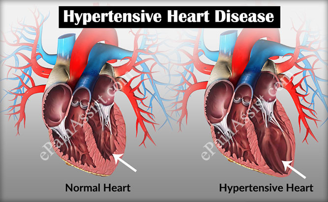 Dr. Naval Parikh: Hypertension Symptoms, Causes & Treatments
