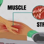 Sprain and Muscle Strain Treatment & Guide